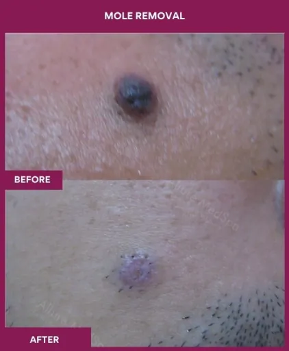 4 Mole Removal
