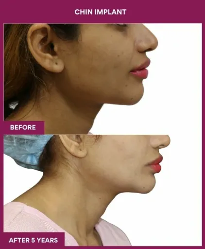 5 Chin Implant (2)