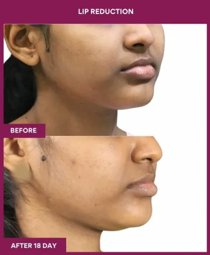 5 LIP REDUCTION (2)