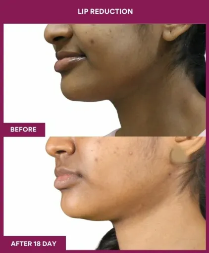 5 LIP REDUCTION (3)