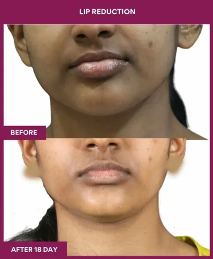 5 LIP REDUCTION