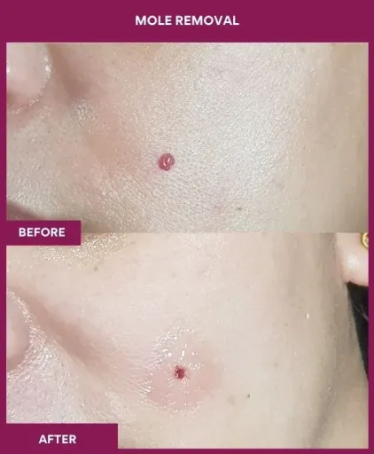 5 Mole Removal_1_