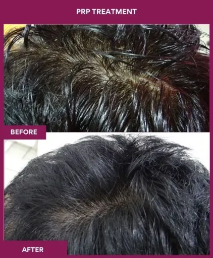 5 PRP Treatment_5