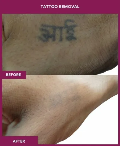 Tattoo removal treatment in Mumbai