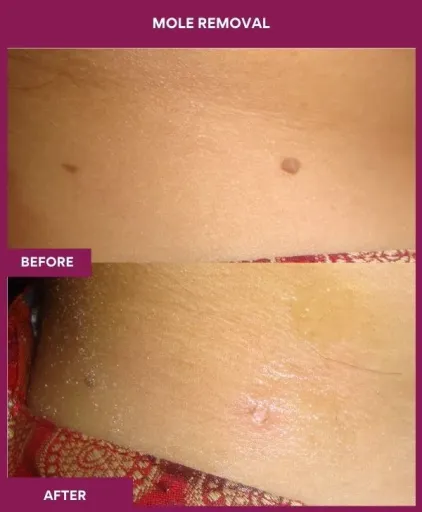 6 Mole Removal_2_