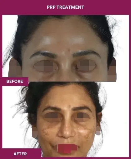 6 PRP Treatment_8 (1)