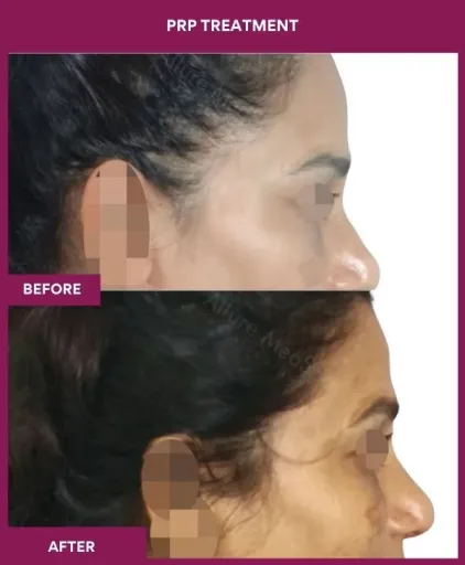 6 PRP Treatment_8 (2)