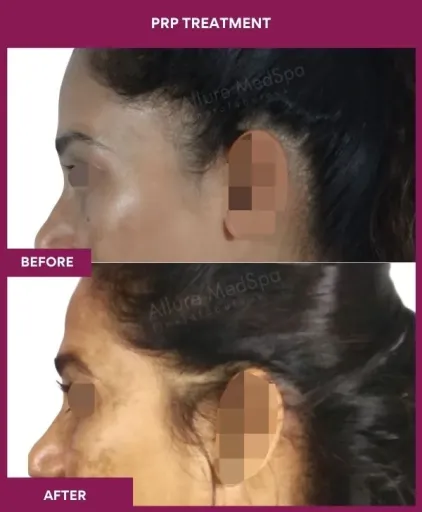 6 PRP Treatment_8 (3)