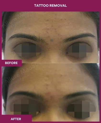 Tattoo removal treatment in Mumbai