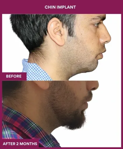 7 Chin Implant (3)