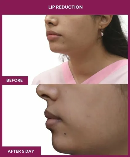 7 LIP REDUCTION (2)