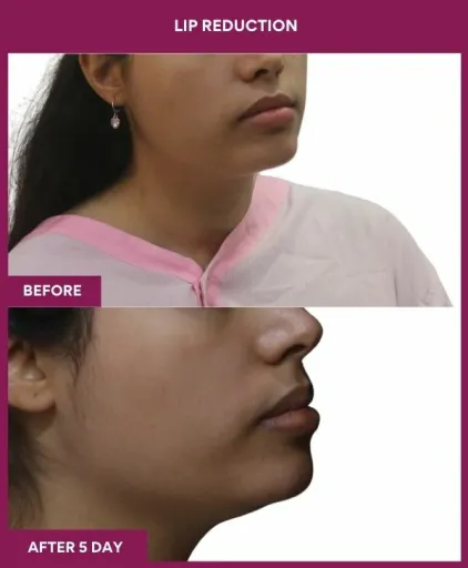 7 LIP REDUCTION (3)