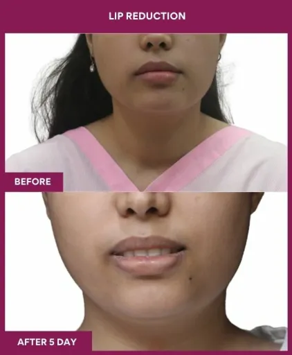7 LIP REDUCTION