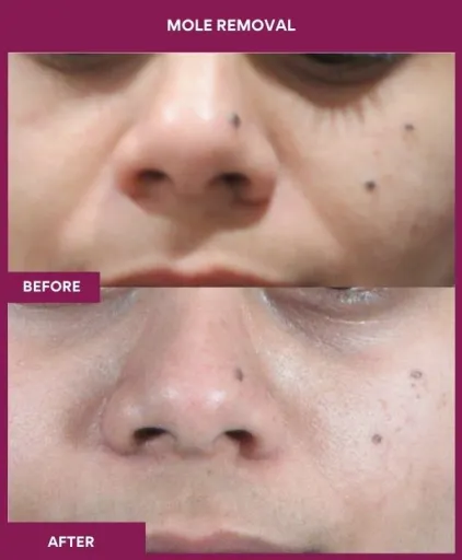 7 Mole Removal