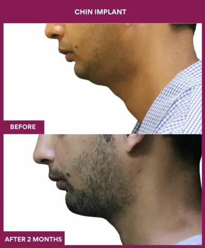 8 Chin Implant (2)