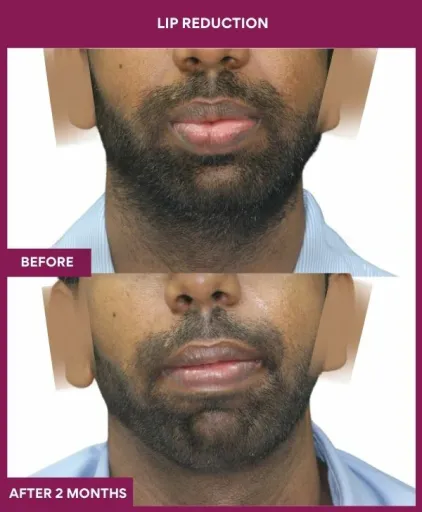 8 LIP REDUCTION