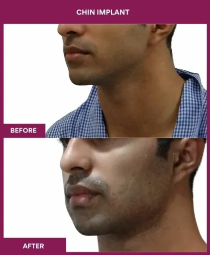 9 Chin Implant (3)