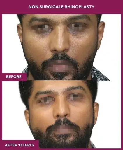 Non-surgical rhinoplasty before and after front view in Mumbai, India