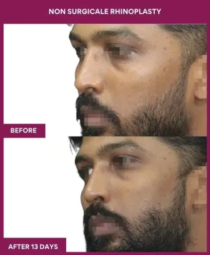 Non-surgical rhinoplasty before and after left side view in Mumbai =, India