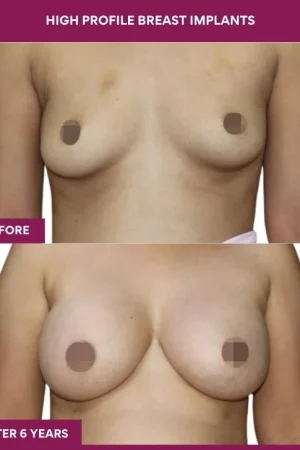 1 High Profile Breast Implants (4)_1