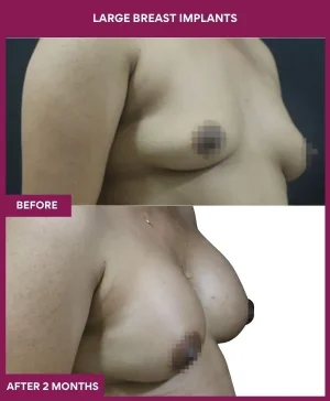 1 Large Breast Implants (2)_1