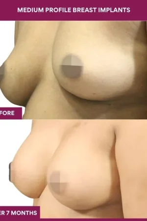 1 Medium Profile Breast Implants (2)_1