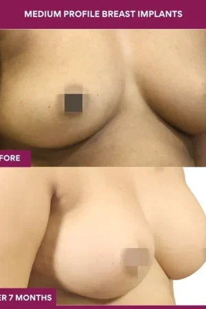 1 Medium Profile Breast Implants (3)_2