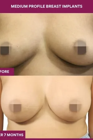 1 Medium Profile Breast Implants_3