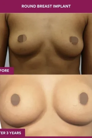 1 Round breast implant (4)_2