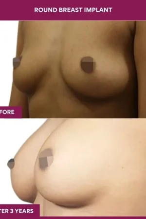 1 Round breast implant (5)_2