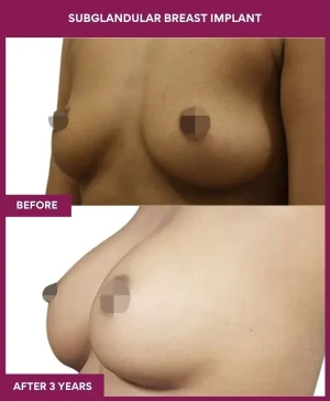 1 SUBGLANDULAR BREAST IMPLANT (2)_1