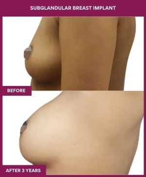 1 SUBGLANDULAR BREAST IMPLANT (3)_1