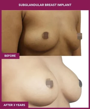 1 SUBGLANDULAR BREAST IMPLANT (4)_1