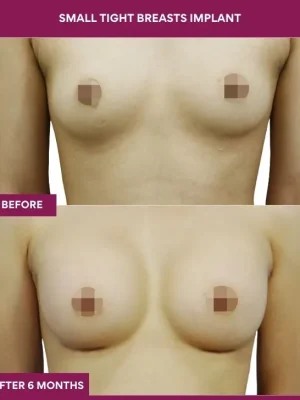 1 Small Tight Breasts Implant (4)_1