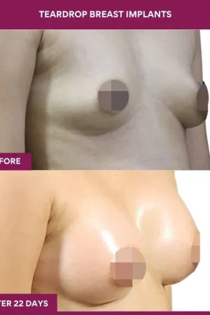 1 Teardrop Breast Implants (3)_1