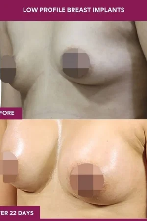 1 low Profile Breast Implants (2)_
