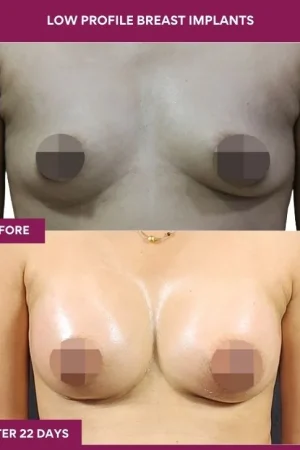 1 low Profile Breast Implants (4)_