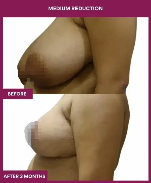 1 medium reduction (2)