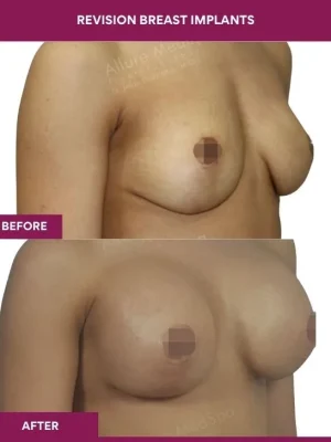 1 revision Breast Implants (2)_1
