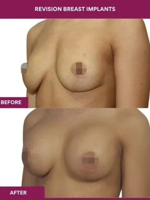 1 revision Breast Implants (3)_2