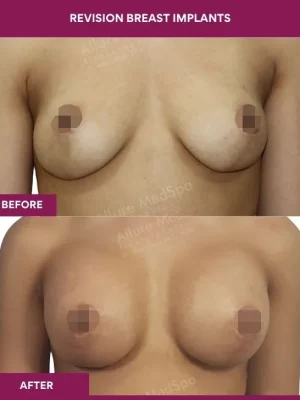 1 revision Breast Implants_3
