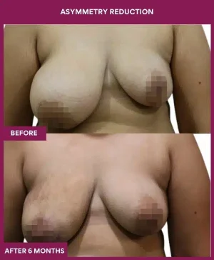 2 Asymmetry Reduction