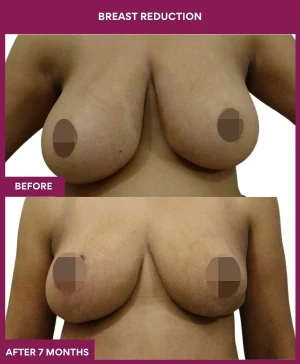 2 BREAST REDUCTION