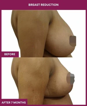 2 BREAST REDUCTION (3)