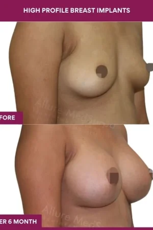 2 High Profile Breast Implants (3)_5_