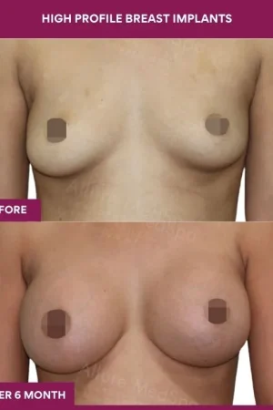 2 High Profile Breast Implants (4)_5_