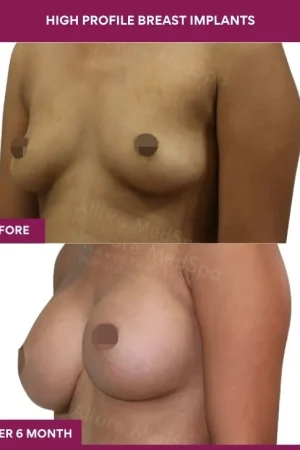 2 High Profile Breast Implants (5)_5_