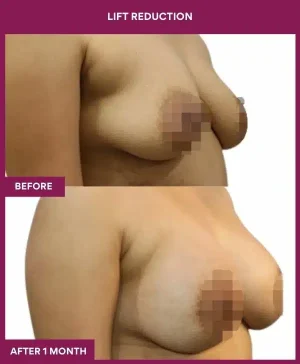 2 Lift reduction (2)