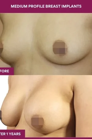2 Medium Profile Breast Implants (2)_4