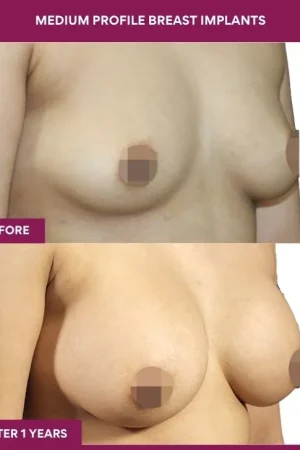 2 Medium Profile Breast Implants (3)_5